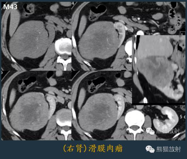 【PPT】滑膜肉瘤影像表现与病理相关性【RG精选】