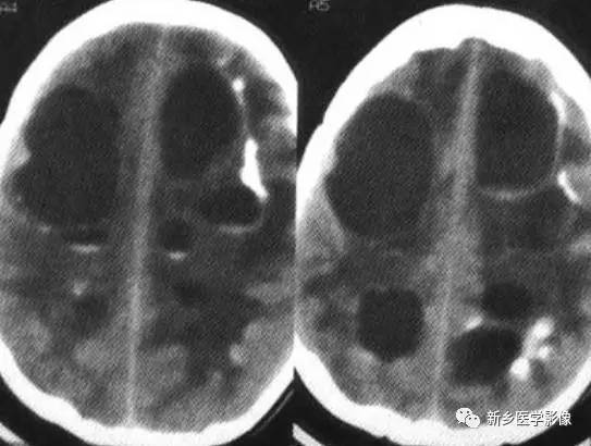 34种颅内可以钙化的病变汇总 34种颅内可以钙化的病变汇总