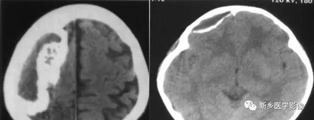 34种颅内可以钙化的病变汇总 34种颅内可以钙化的病变汇总