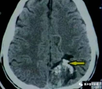 34种颅内可以钙化的病变汇总