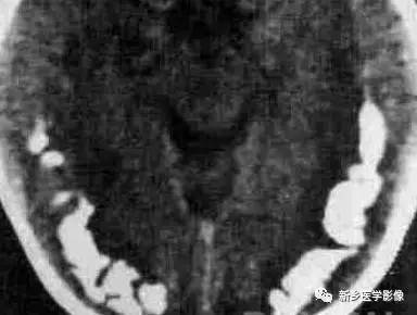 34种颅内可以钙化的病变汇总 34种颅内可以钙化的病变汇总