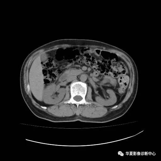 【病例】肾盂癌1例CT影像表现 【病例】肾盂癌1例CT影像表现