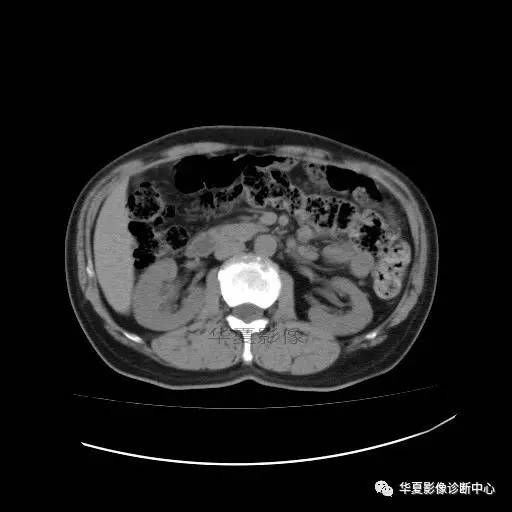 【病例】肾盂癌1例CT影像表现 【病例】肾盂癌1例CT影像表现
