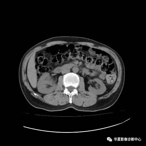 【病例】肾盂癌1例CT影像表现 【病例】肾盂癌1例CT影像表现