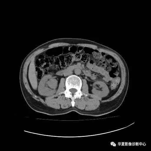 【病例】肾盂癌1例CT影像表现 【病例】肾盂癌1例CT影像表现