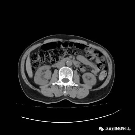 【病例】肾盂癌1例CT影像表现 【病例】肾盂癌1例CT影像表现