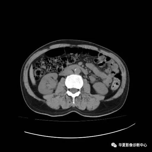 【病例】肾盂癌1例CT影像表现 【病例】肾盂癌1例CT影像表现