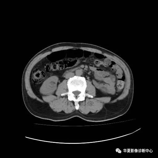 【病例】肾盂癌1例CT影像表现 【病例】肾盂癌1例CT影像表现