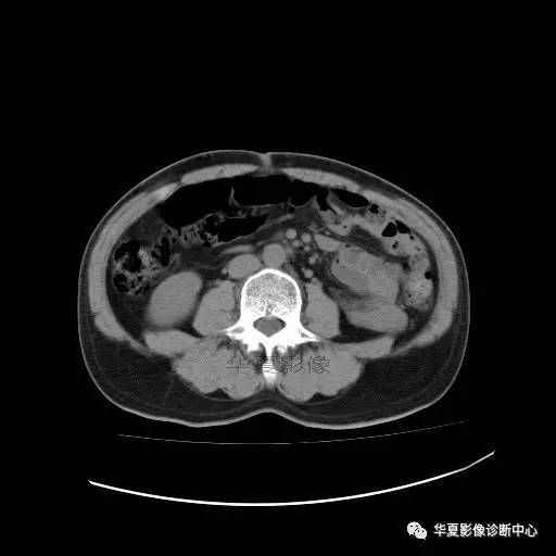 【病例】肾盂癌1例CT影像表现 【病例】肾盂癌1例CT影像表现