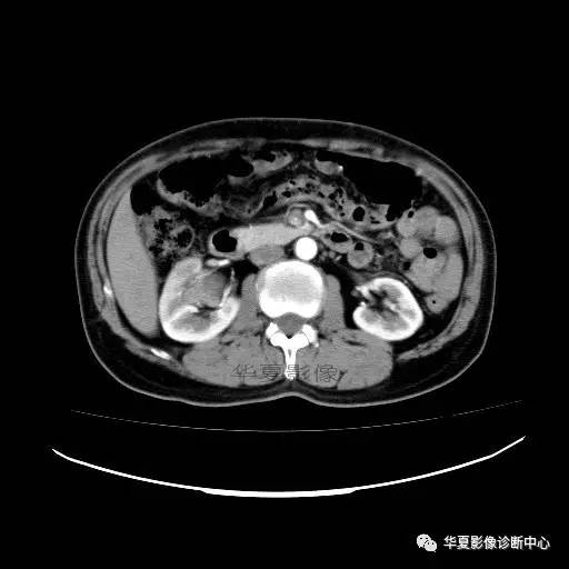 【病例】肾盂癌1例CT影像表现 【病例】肾盂癌1例CT影像表现