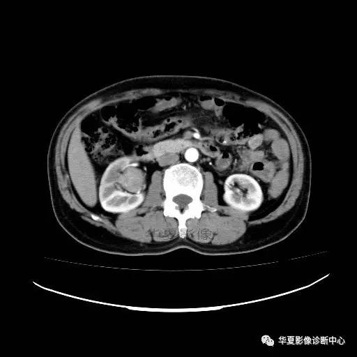 【病例】肾盂癌1例CT影像表现 【病例】肾盂癌1例CT影像表现