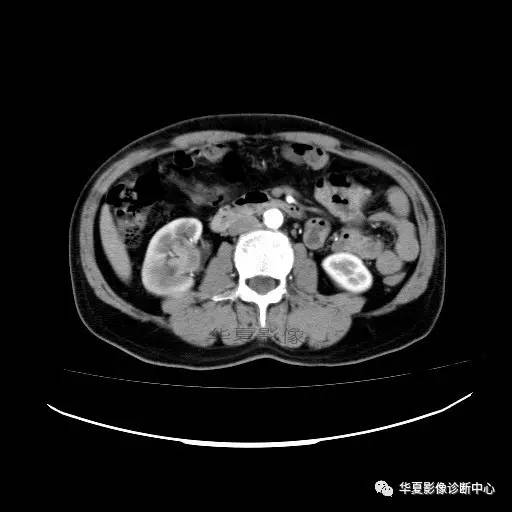 【病例】肾盂癌1例CT影像表现 【病例】肾盂癌1例CT影像表现