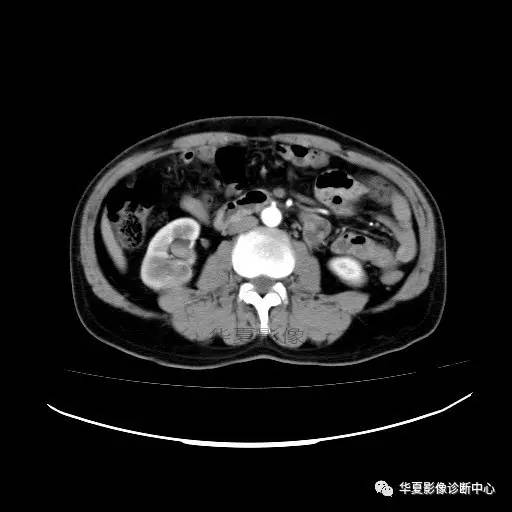 【病例】肾盂癌1例CT影像表现 【病例】肾盂癌1例CT影像表现