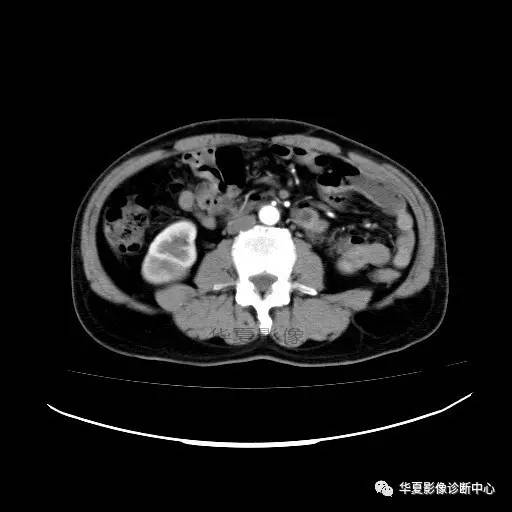 【病例】肾盂癌1例CT影像表现 【病例】肾盂癌1例CT影像表现
