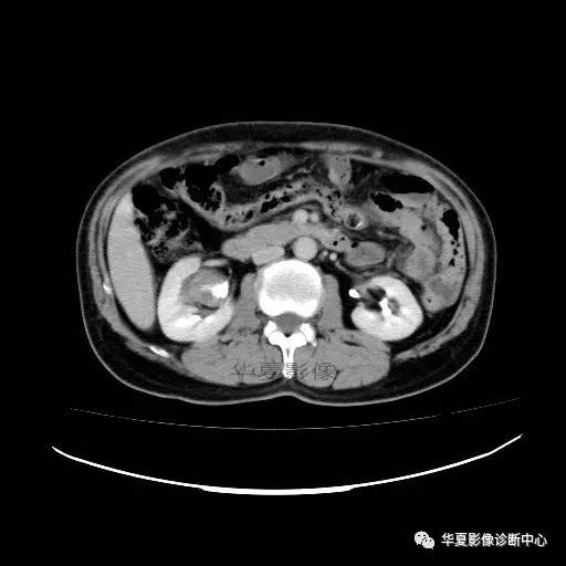 【病例】肾盂癌1例CT影像表现 【病例】肾盂癌1例CT影像表现