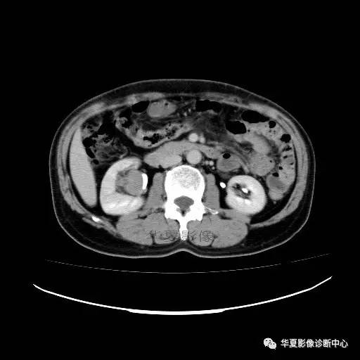 【病例】肾盂癌1例CT影像表现 【病例】肾盂癌1例CT影像表现