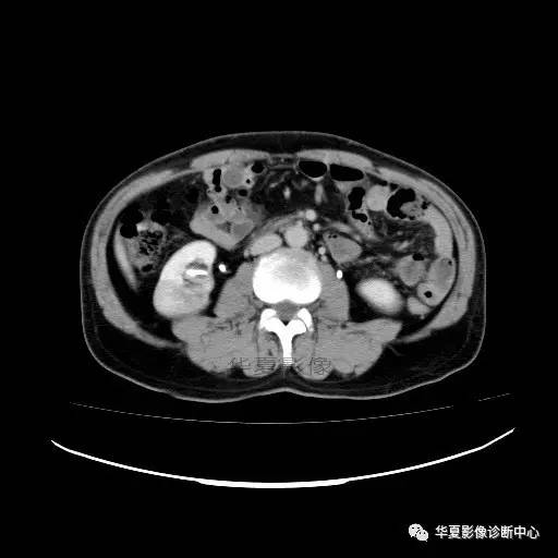 【病例】肾盂癌1例CT影像表现 【病例】肾盂癌1例CT影像表现