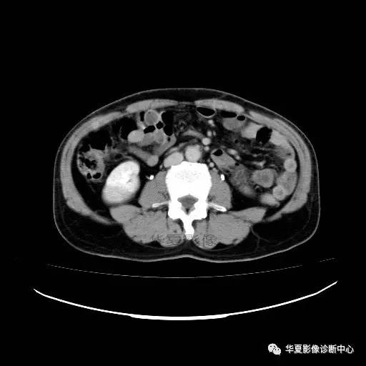【病例】肾盂癌1例CT影像表现 【病例】肾盂癌1例CT影像表现