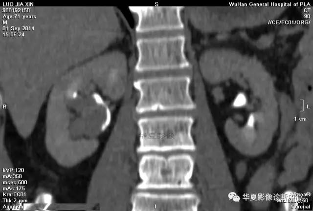 【病例】肾盂癌1例CT影像表现 【病例】肾盂癌1例CT影像表现
