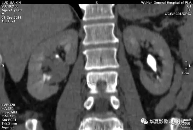 【病例】肾盂癌1例CT影像表现 【病例】肾盂癌1例CT影像表现