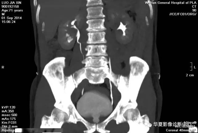 【病例】肾盂癌1例CT影像表现 【病例】肾盂癌1例CT影像表现