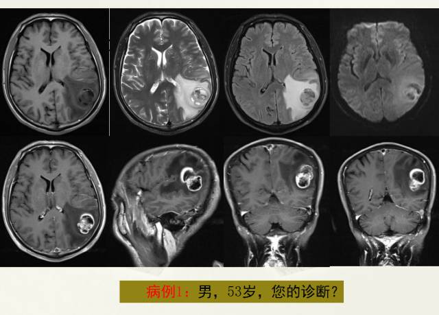 【PPT】脑转移瘤诊断与鉴别