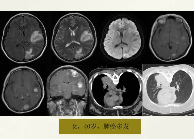 【PPT】脑转移瘤诊断与鉴别