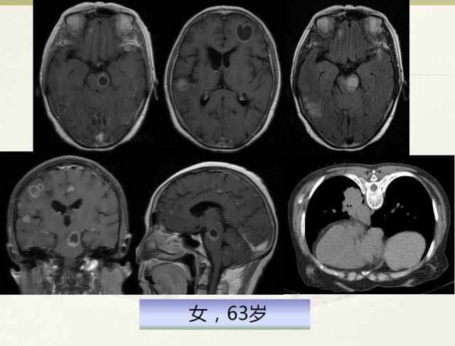 【PPT】脑转移瘤诊断与鉴别