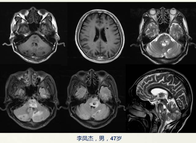 【PPT】脑转移瘤诊断与鉴别