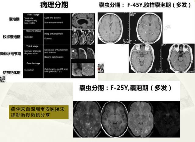 【PPT】脑转移瘤诊断与鉴别