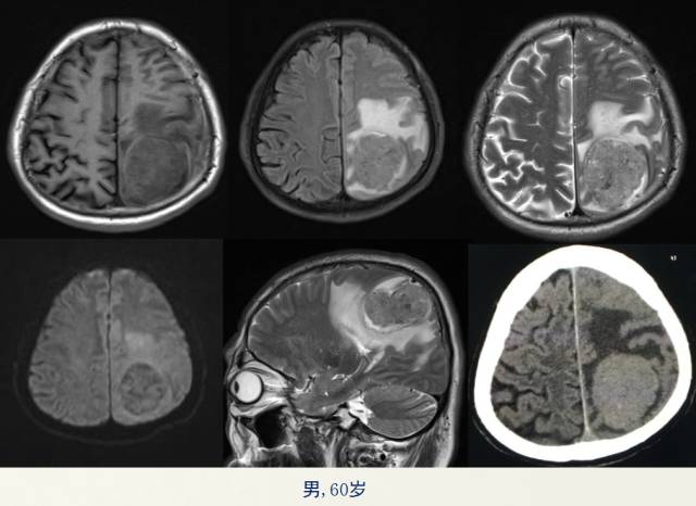 【PPT】脑转移瘤诊断与鉴别