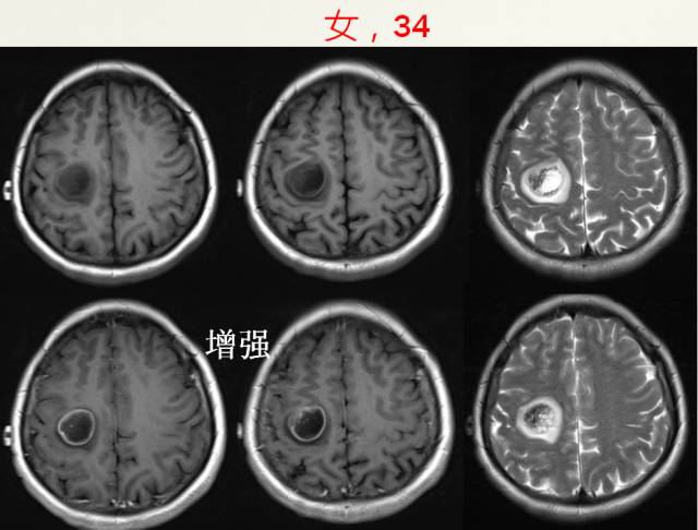 【PPT】脑转移瘤诊断与鉴别