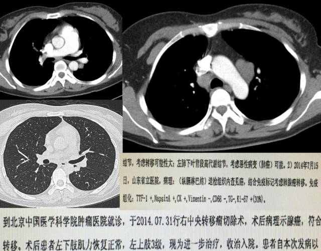 【PPT】脑转移瘤诊断与鉴别