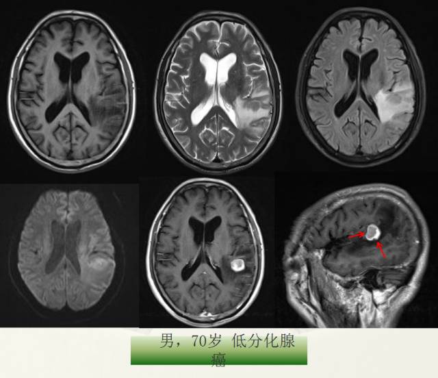 【PPT】脑转移瘤诊断与鉴别