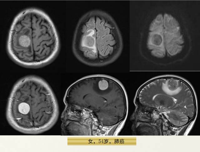【PPT】脑转移瘤诊断与鉴别