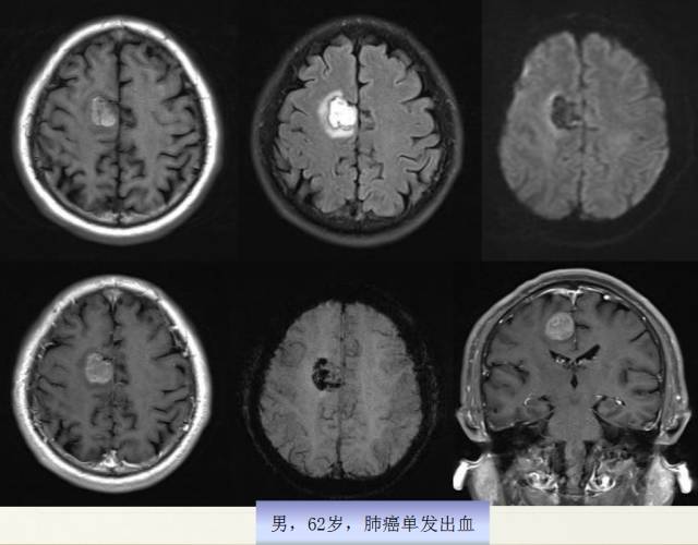 【PPT】脑转移瘤诊断与鉴别