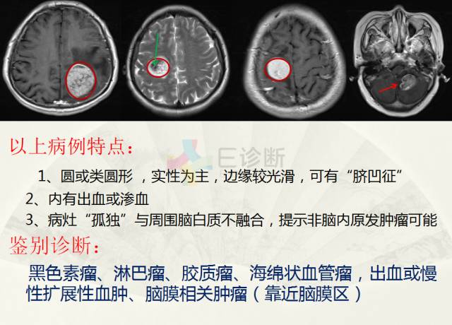 【PPT】脑转移瘤诊断与鉴别
