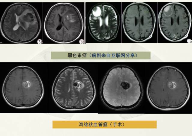 【PPT】脑转移瘤诊断与鉴别