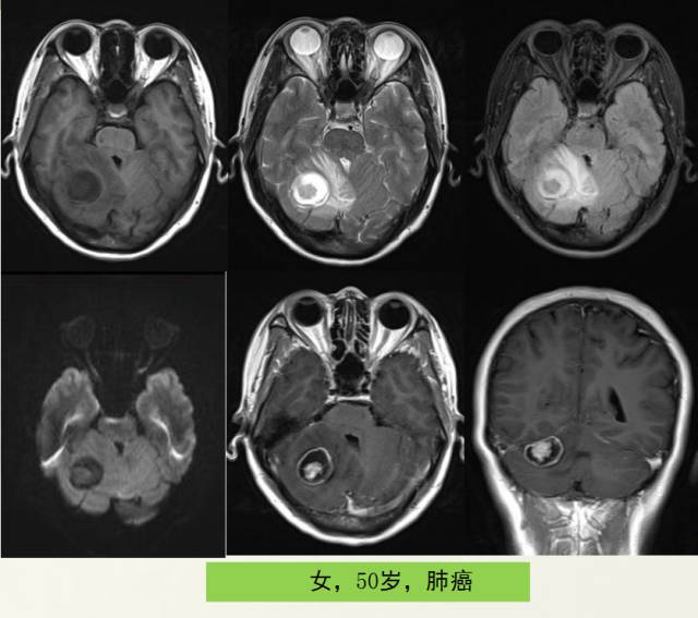 【PPT】脑转移瘤诊断与鉴别