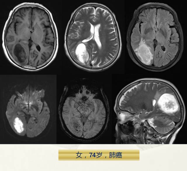【PPT】脑转移瘤诊断与鉴别