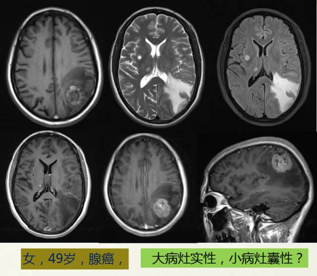 【PPT】脑转移瘤诊断与鉴别