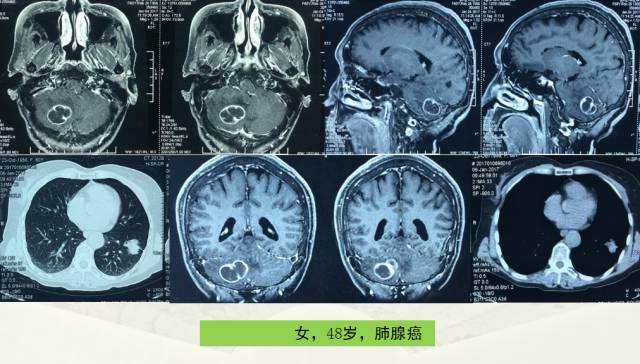 【PPT】脑转移瘤诊断与鉴别