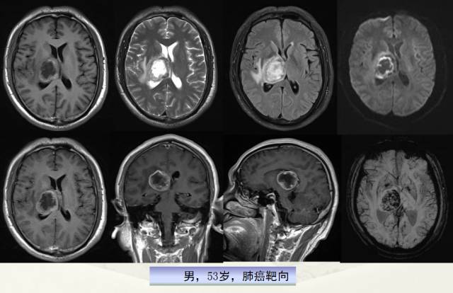 【PPT】脑转移瘤诊断与鉴别