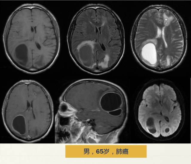 【PPT】脑转移瘤诊断与鉴别
