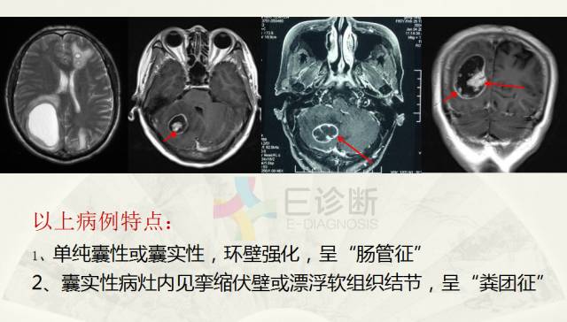 【PPT】脑转移瘤诊断与鉴别