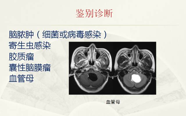 【PPT】脑转移瘤诊断与鉴别