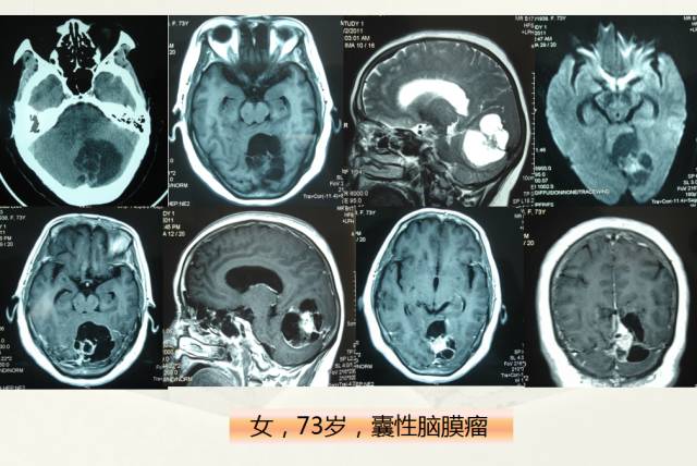 【PPT】脑转移瘤诊断与鉴别