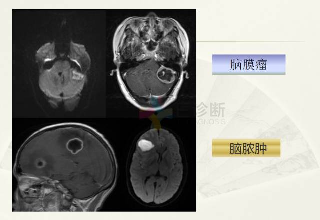 【PPT】脑转移瘤诊断与鉴别