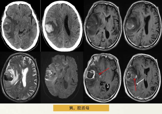 【PPT】脑转移瘤诊断与鉴别