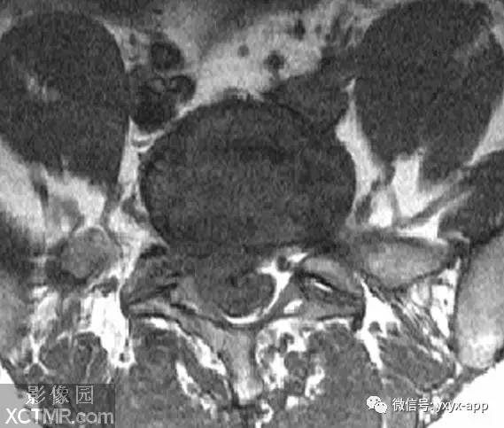 【病例】腰椎间盘突出1例MRI影像诊断分析 【病例】腰椎间盘突出1例MRI影像诊断分析
